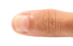 Comment Soigner Naturellement Les Mycoses Aux Ongles Pratique Ch